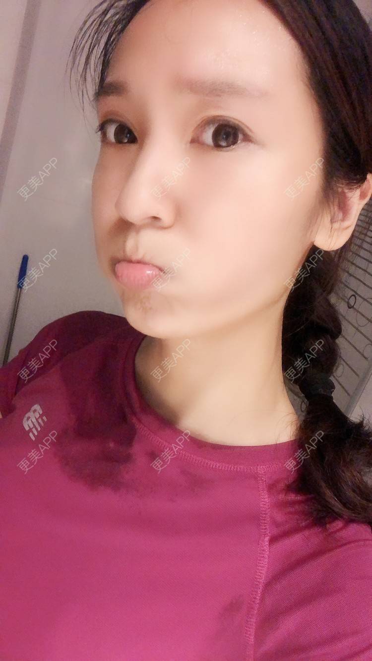 更美 - 时代新青年的经验 | 杭州 | 自体脂肪全面部填充 | 自体脂肪全面填充 | 视频日记