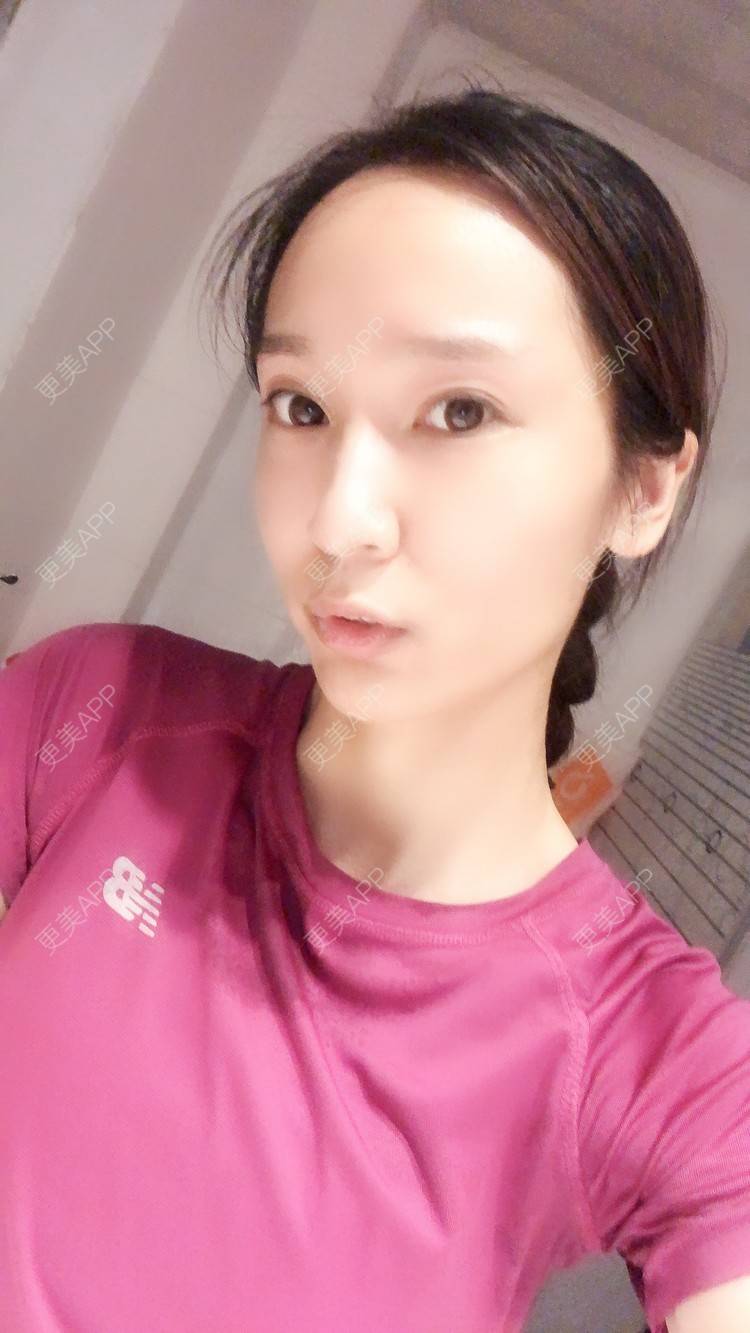更美 - 时代新青年的经验 | 杭州 | 自体脂肪全面部填充 | 自体脂肪全面填充 | 视频日记