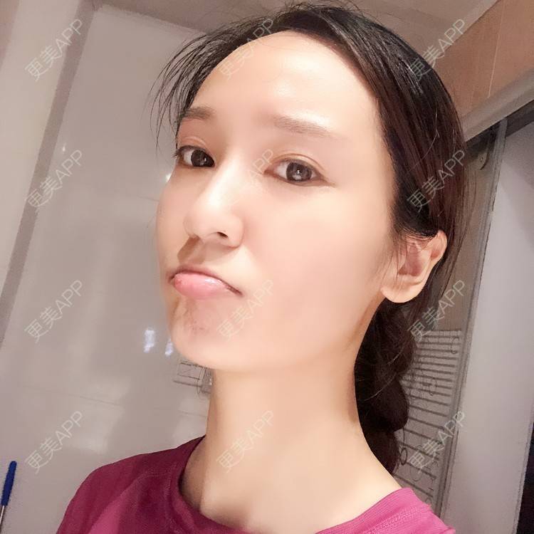 更美 - 时代新青年的经验 | 杭州 | 自体脂肪全面部填充 | 自体脂肪全面填充 | 视频日记