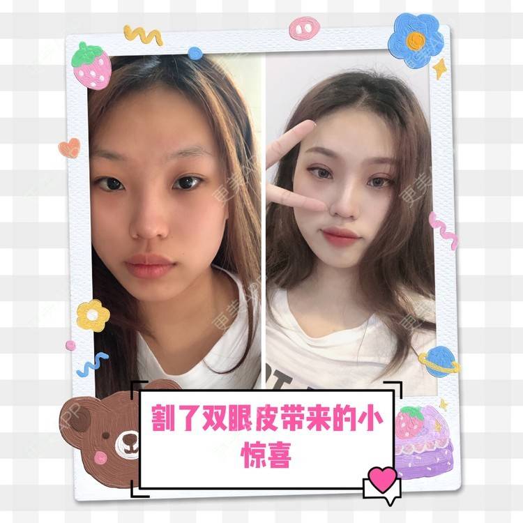更美 - 二闪亮晶晶的全切双眼皮经验 | 广州 | 全切双眼皮