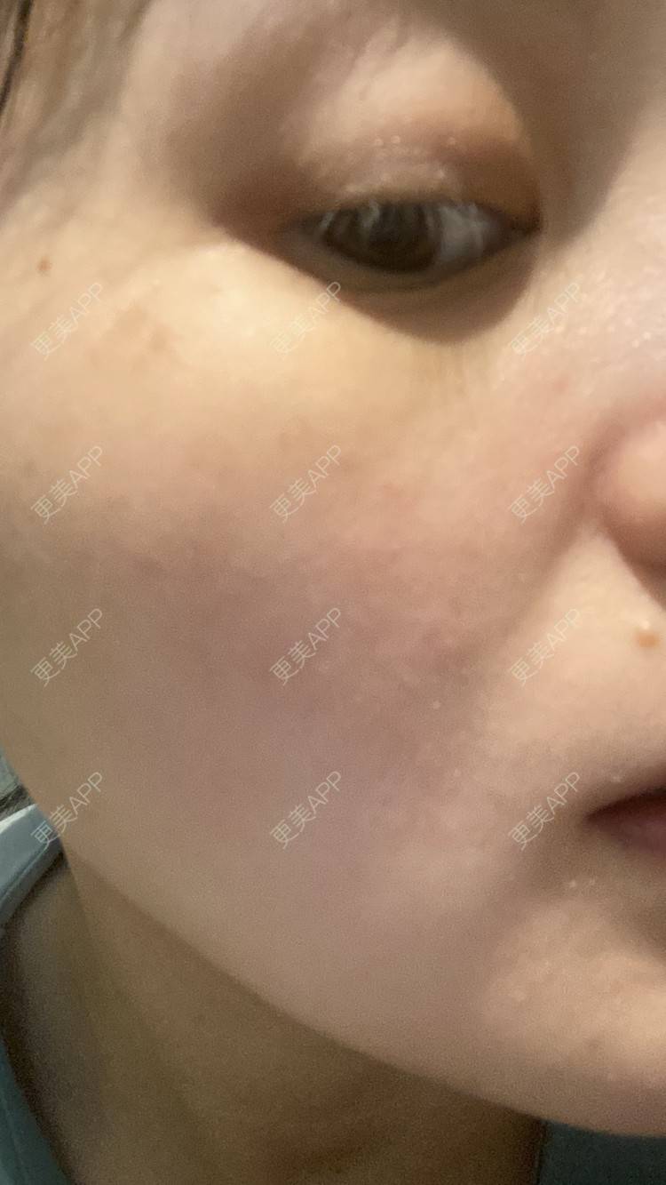 更美 - 一白遮三丑丑丑的热拉提经验 | 上海 | 热拉提