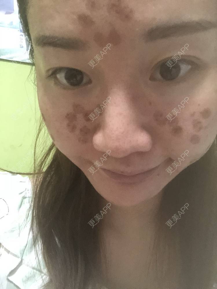 更美 - 更美用户KypVf5ovVE的点阵激光经验 | 上海 | 点阵激光