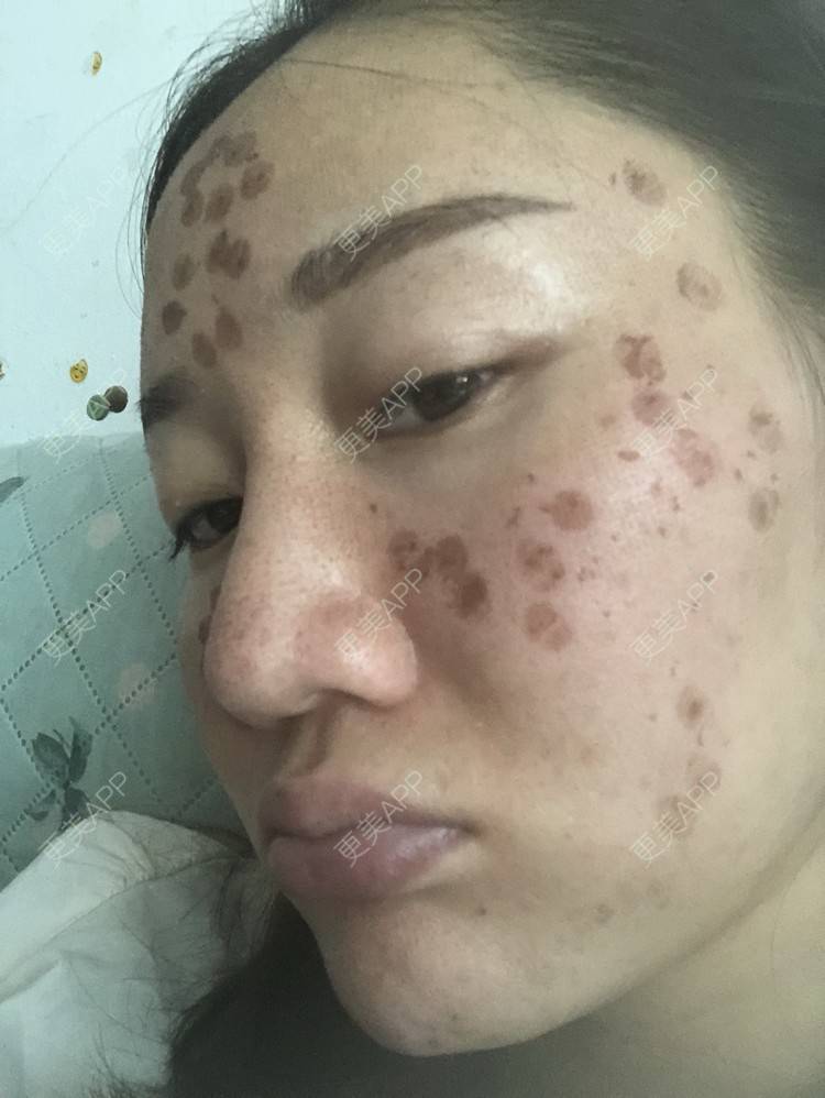 更美 - 更美用户KypVf5ovVE的点阵激光经验 | 上海 | 点阵激光