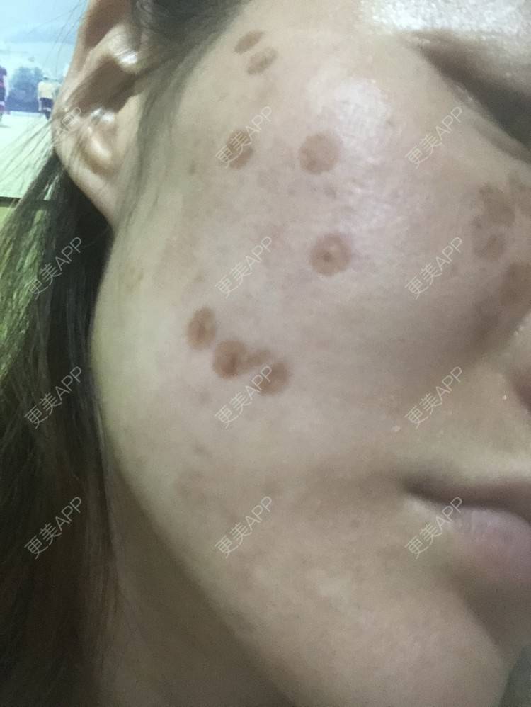 更美 - 更美用户KypVf5ovVE的点阵激光经验 | 上海 | 点阵激光