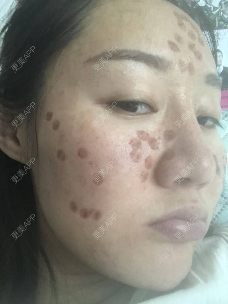 更美 - 更美用户KypVf5ovVE的点阵激光经验 | 上海 | 点阵激光