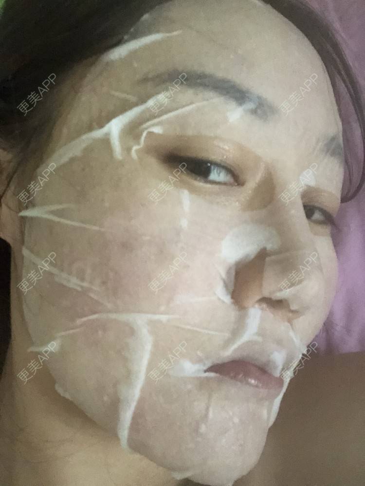 更美 - 更美用户KypVf5ovVE的点阵激光经验 | 上海 | 点阵激光