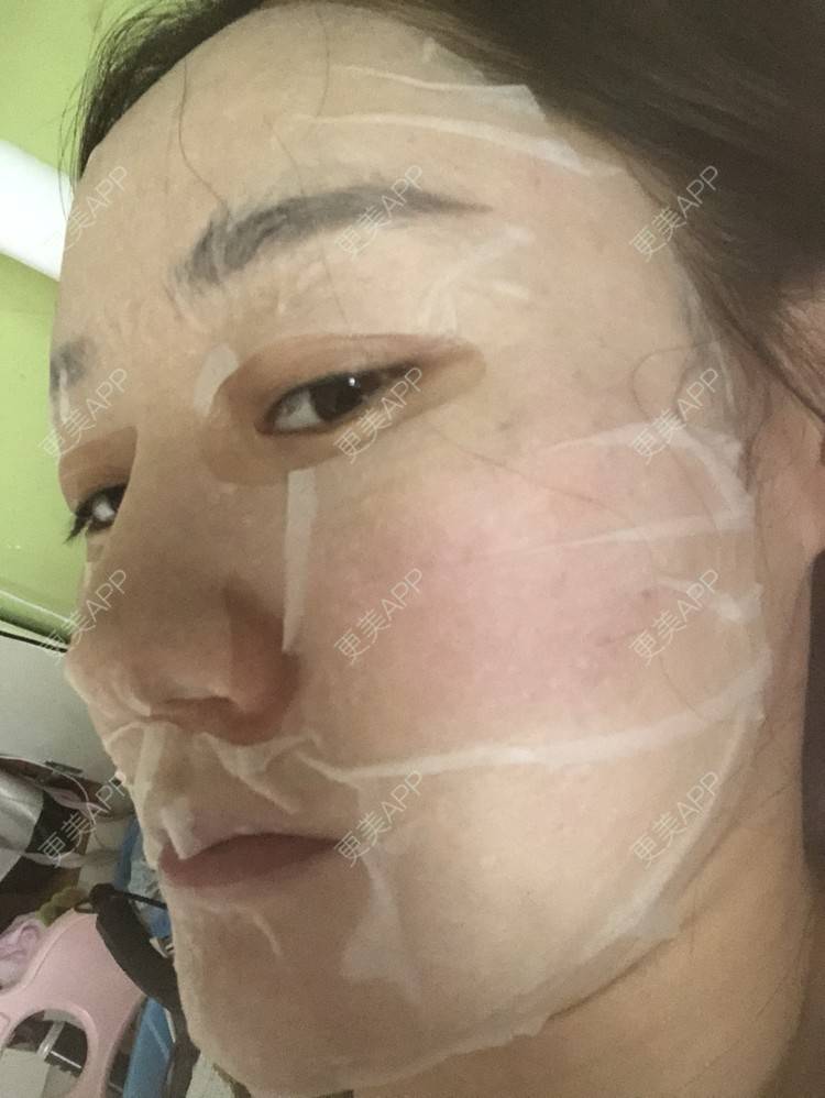 更美 - 更美用户KypVf5ovVE的点阵激光经验 | 上海 | 点阵激光