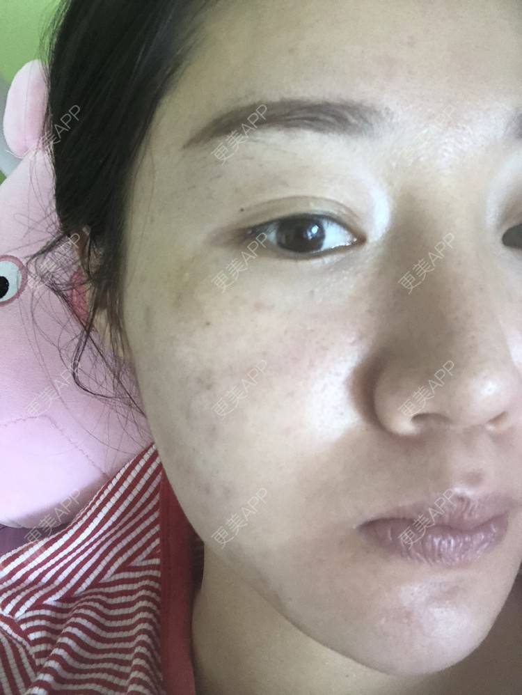 更美 - 更美用户KypVf5ovVE的点阵激光经验 | 上海 | 点阵激光