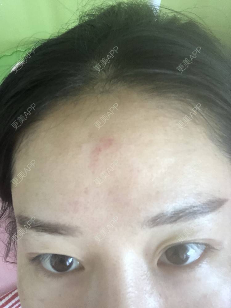 更美 - 更美用户KypVf5ovVE的点阵激光经验 | 上海 | 点阵激光