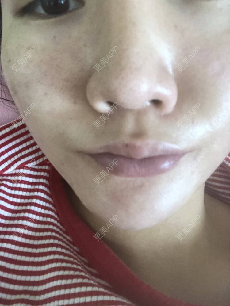 更美 - 更美用户KypVf5ovVE的点阵激光经验 | 上海 | 点阵激光