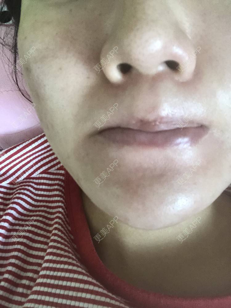 更美 - 更美用户KypVf5ovVE的点阵激光经验 | 上海 | 点阵激光
