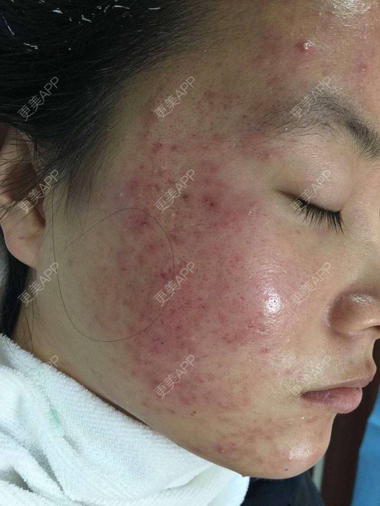 更美 - 是Yoli啊的红蓝光清痘经验 | 广州 | 红蓝光清痘