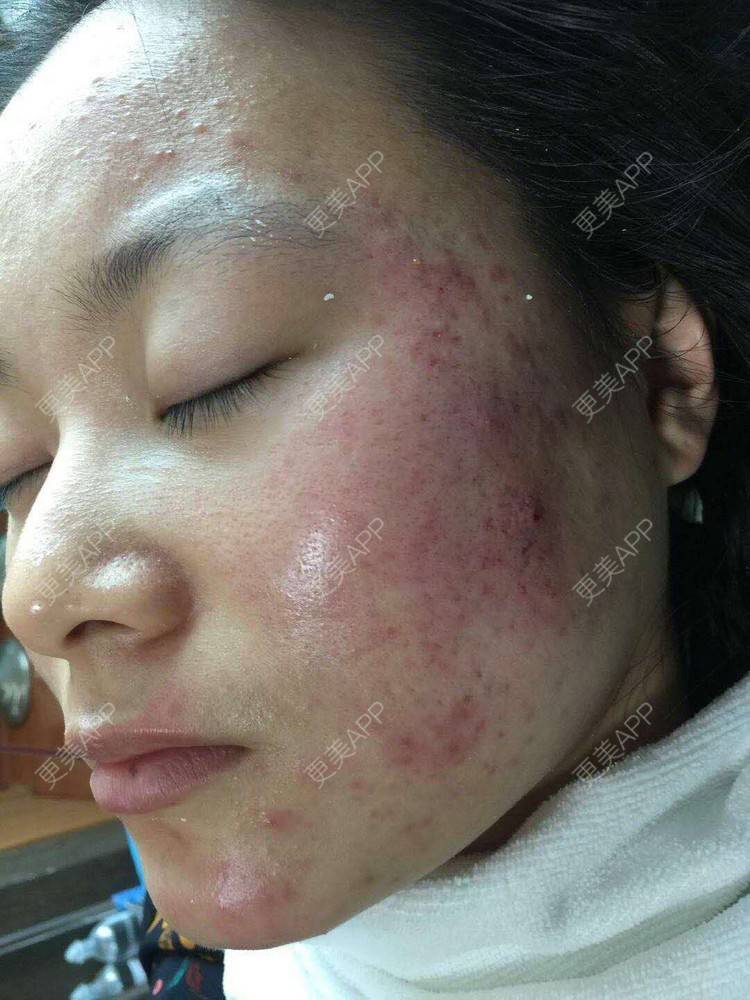 更美 - 是Yoli啊的红蓝光清痘经验 | 广州 | 红蓝光清痘
