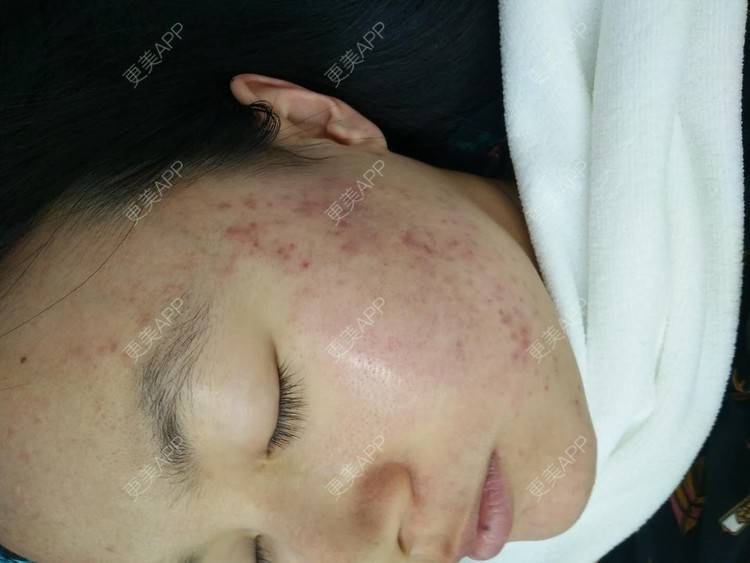 更美 - 是Yoli啊的红蓝光清痘经验 | 广州 | 红蓝光清痘