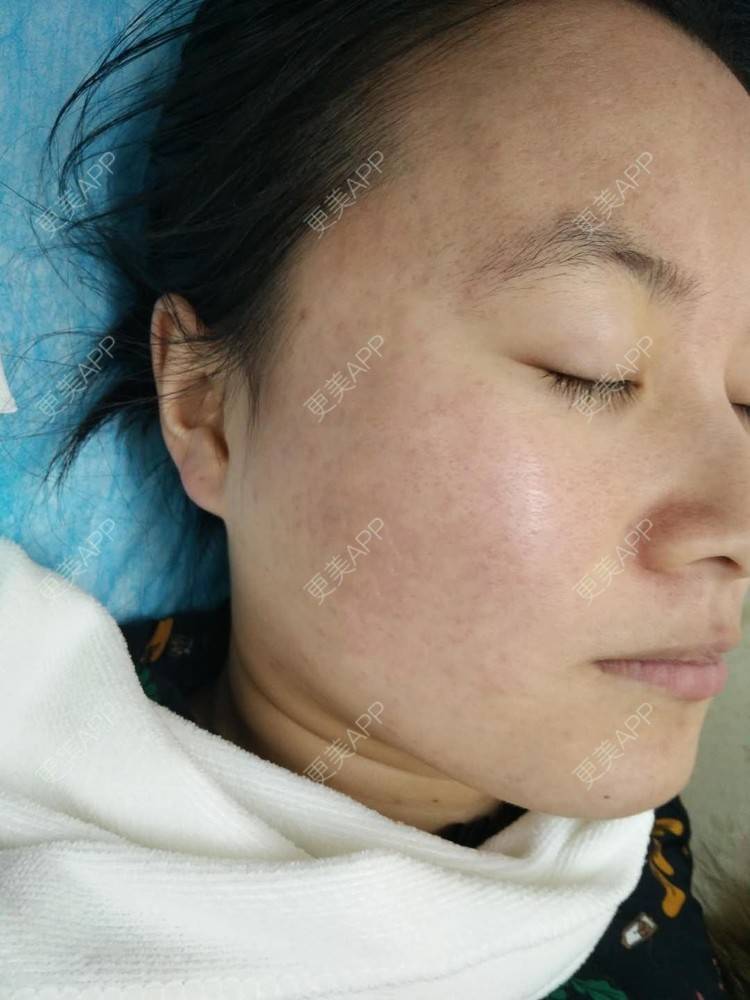 更美 - 是Yoli啊的红蓝光清痘经验 | 广州 | 红蓝光清痘