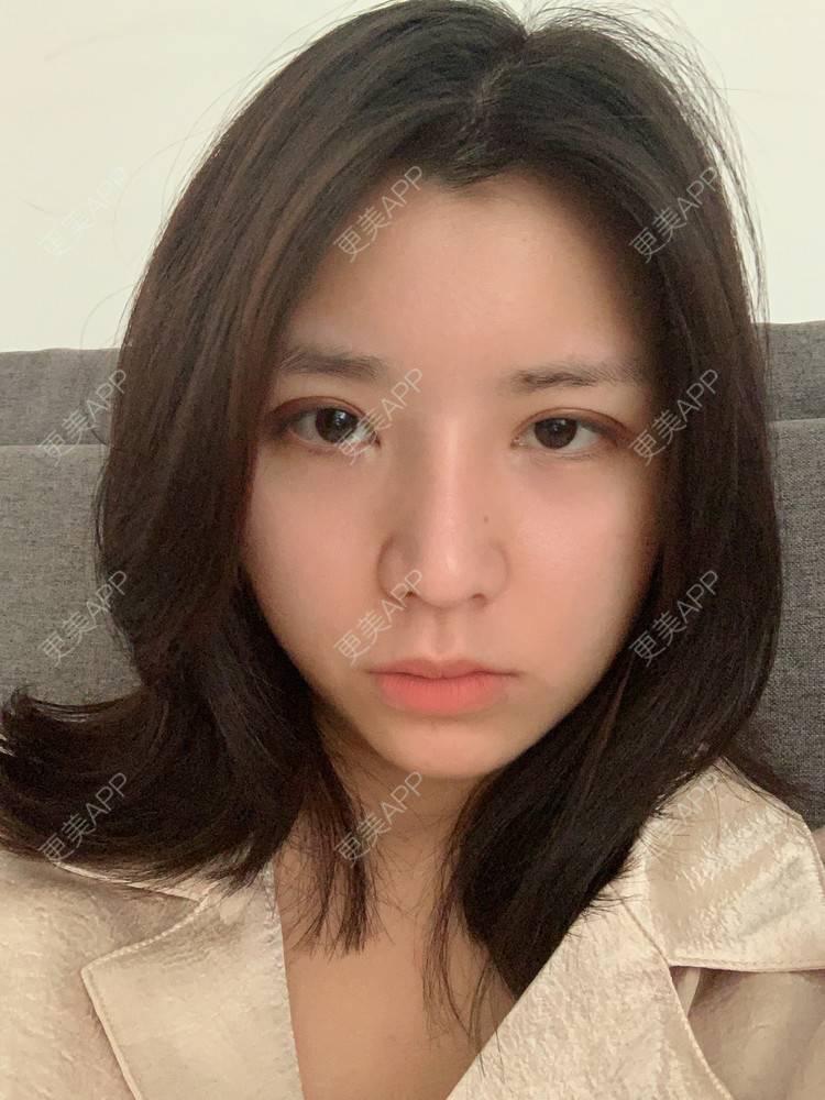 更美 - 更美用户B670A6hUBe的眼部综合经验 | 广州 | 眼部综合