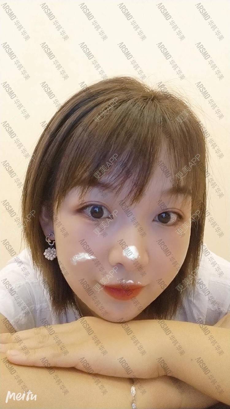 更美 - 摘星怪✨的埋线提升经验 | 埋线提升 | 抗衰紧致 | 埋线除皱 | 射频提升 | 除皱套餐 | 长沙