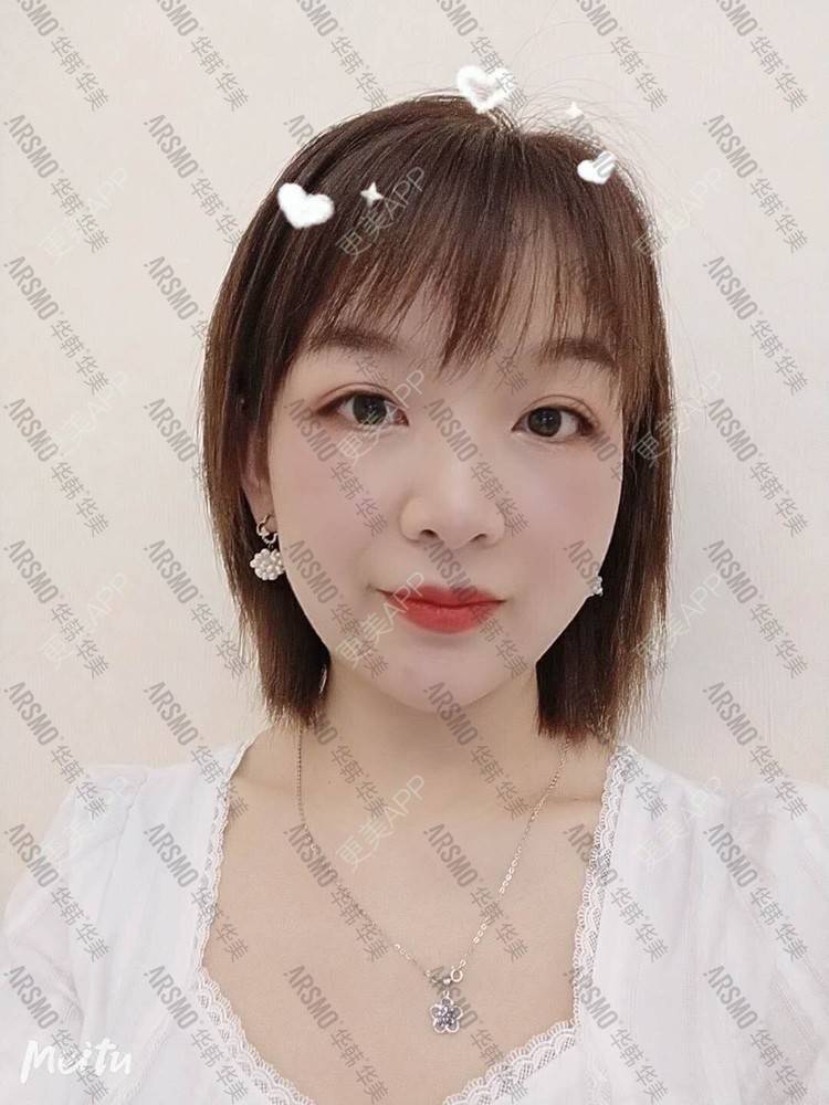 更美 - 摘星怪✨的埋线提升经验 | 埋线提升 | 抗衰紧致 | 埋线除皱 | 射频提升 | 除皱套餐 | 长沙