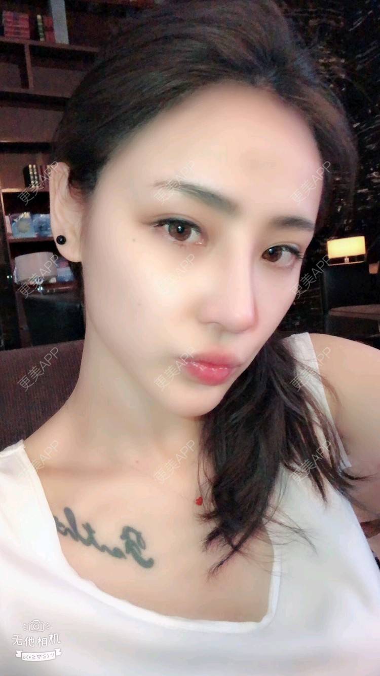 更美 - nanana娜娜娜的隆鼻经验 | 隆鼻 | 膨体隆鼻 | 肋软骨隆鼻 | 膨体垫下巴 | 鼻形态修复