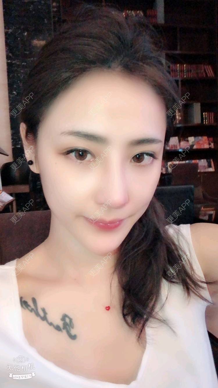更美 - nanana娜娜娜的隆鼻经验 | 隆鼻 | 膨体隆鼻 | 肋软骨隆鼻 | 膨体垫下巴 | 鼻形态修复