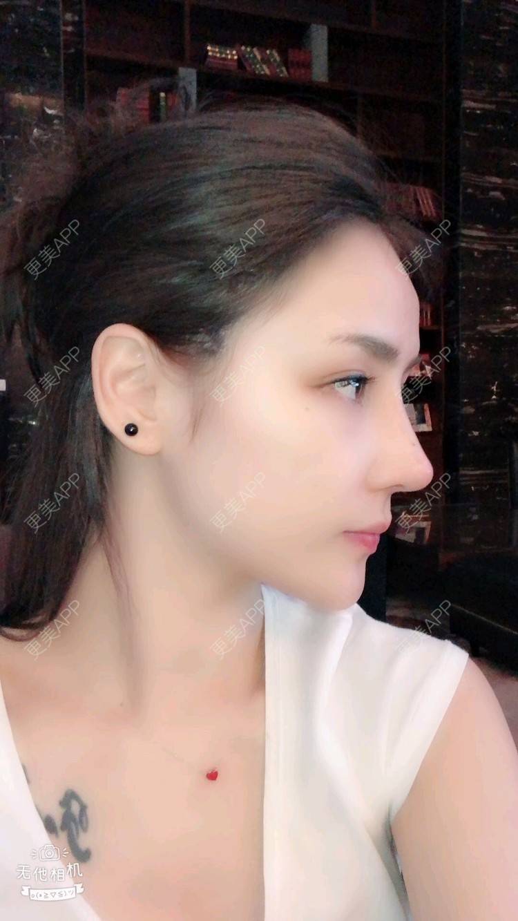 更美 - nanana娜娜娜的隆鼻经验 | 隆鼻 | 膨体隆鼻 | 肋软骨隆鼻 | 膨体垫下巴 | 鼻形态修复