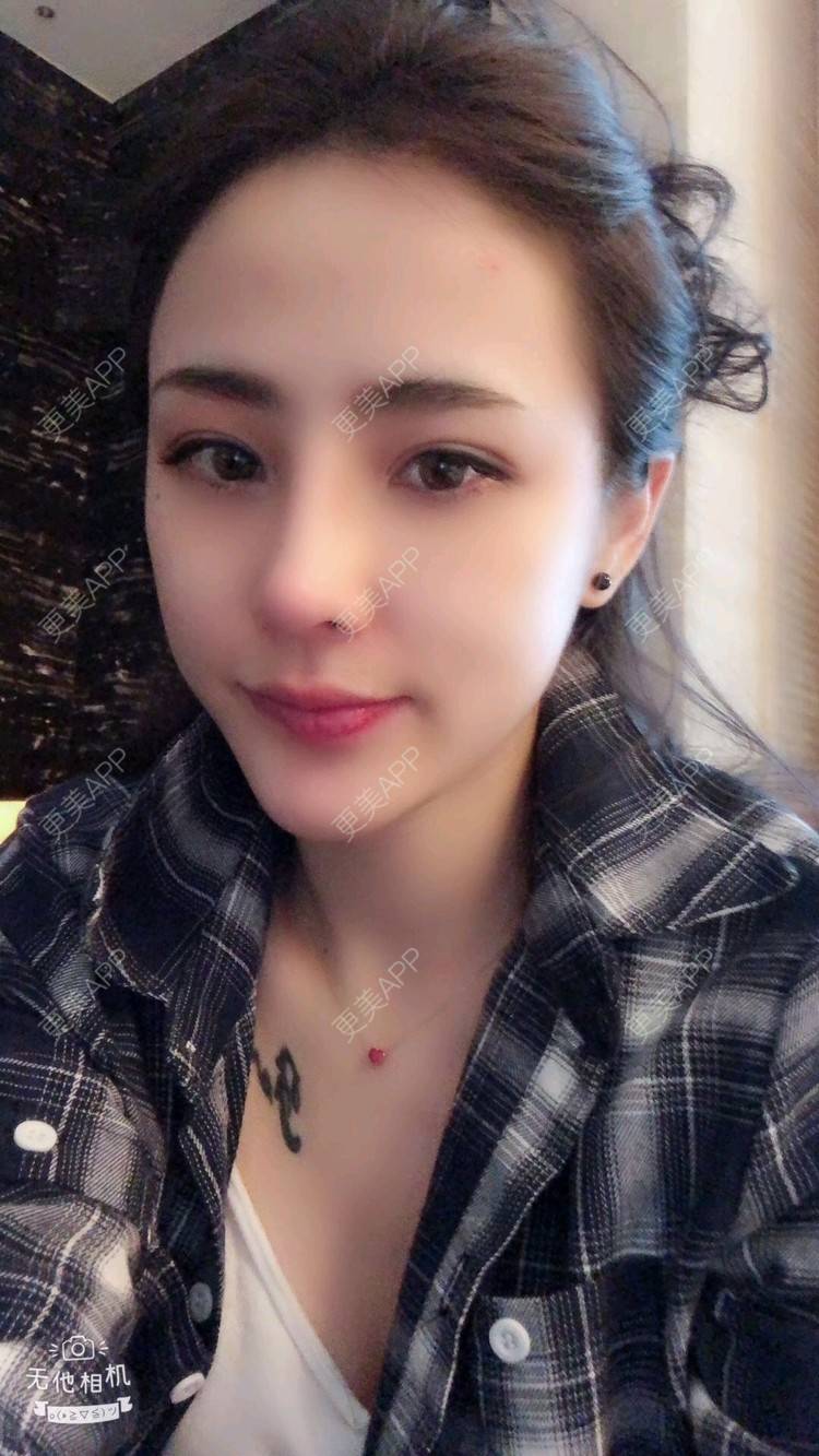 更美 - nanana娜娜娜的隆鼻经验 | 隆鼻 | 膨体隆鼻 | 肋软骨隆鼻 | 膨体垫下巴 | 鼻形态修复