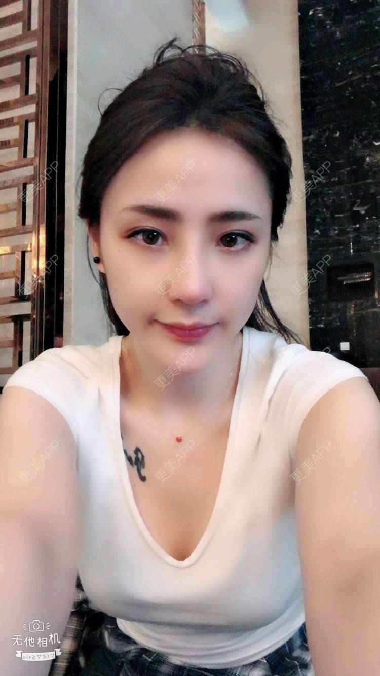 更美 - nanana娜娜娜的隆鼻经验 | 隆鼻 | 膨体隆鼻 | 肋软骨隆鼻 | 膨体垫下巴 | 鼻形态修复