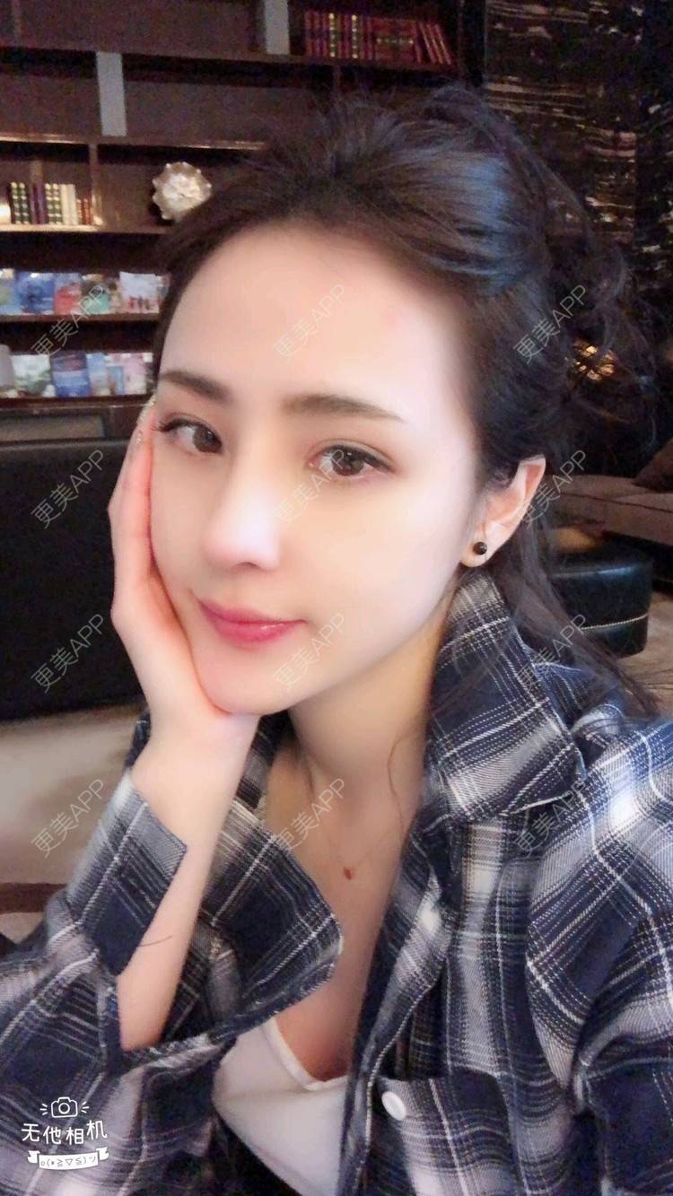 更美 - nanana娜娜娜的隆鼻经验 | 隆鼻 | 膨体隆鼻 | 肋软骨隆鼻 | 膨体垫下巴 | 鼻形态修复