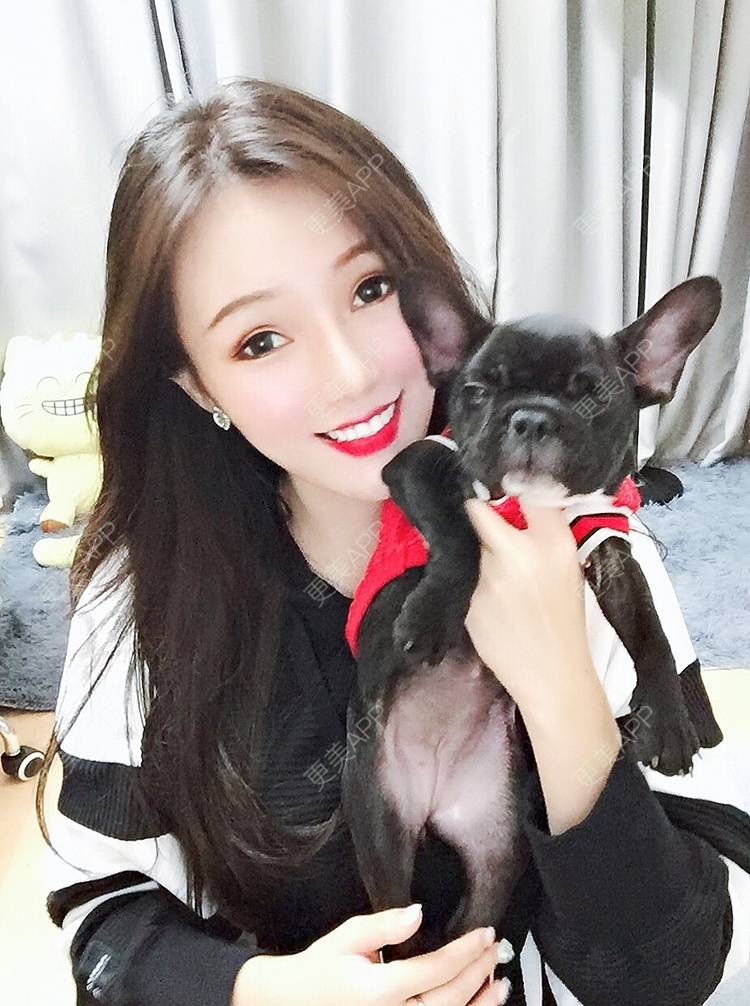 更美 - 美美的芝芝的自体脂肪全面部填充经验 | 广州 | 自体脂肪全面部填充