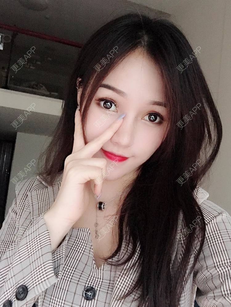 更美 - 美美的芝芝的自体脂肪全面部填充经验 | 广州 | 自体脂肪全面部填充