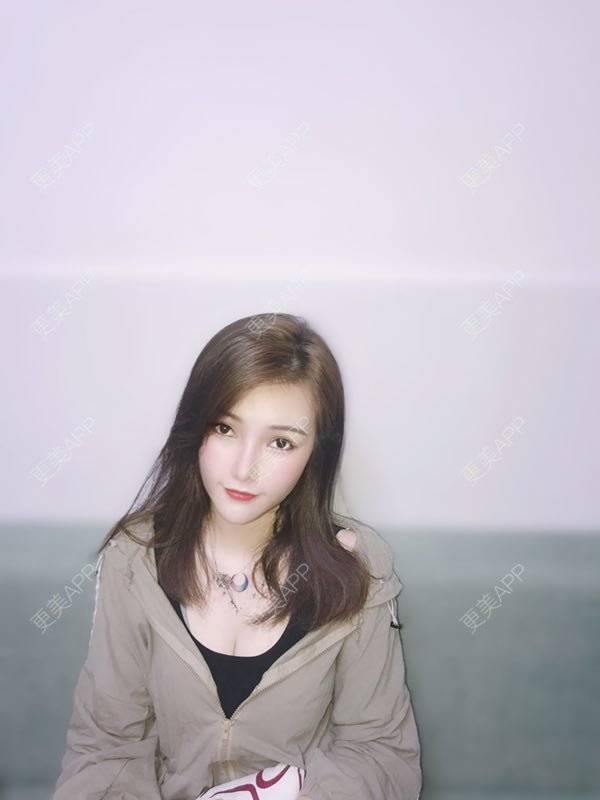 更美 - 美美的芝芝的自体脂肪全面部填充经验 | 广州 | 自体脂肪全面部填充