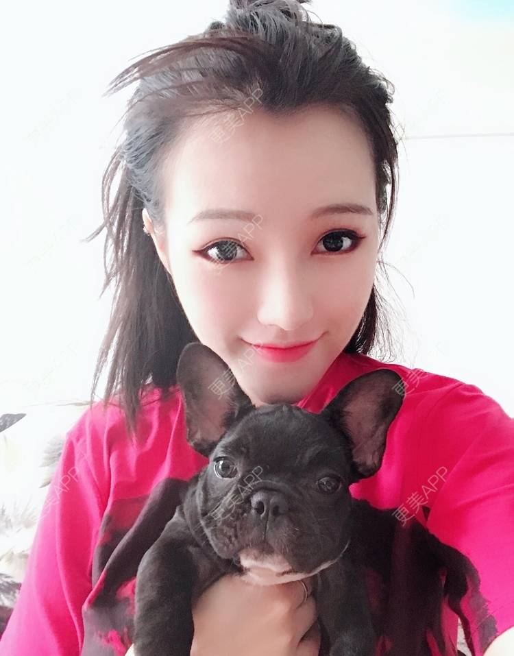 更美 - 美美的芝芝的自体脂肪全面部填充经验 | 广州 | 自体脂肪全面部填充