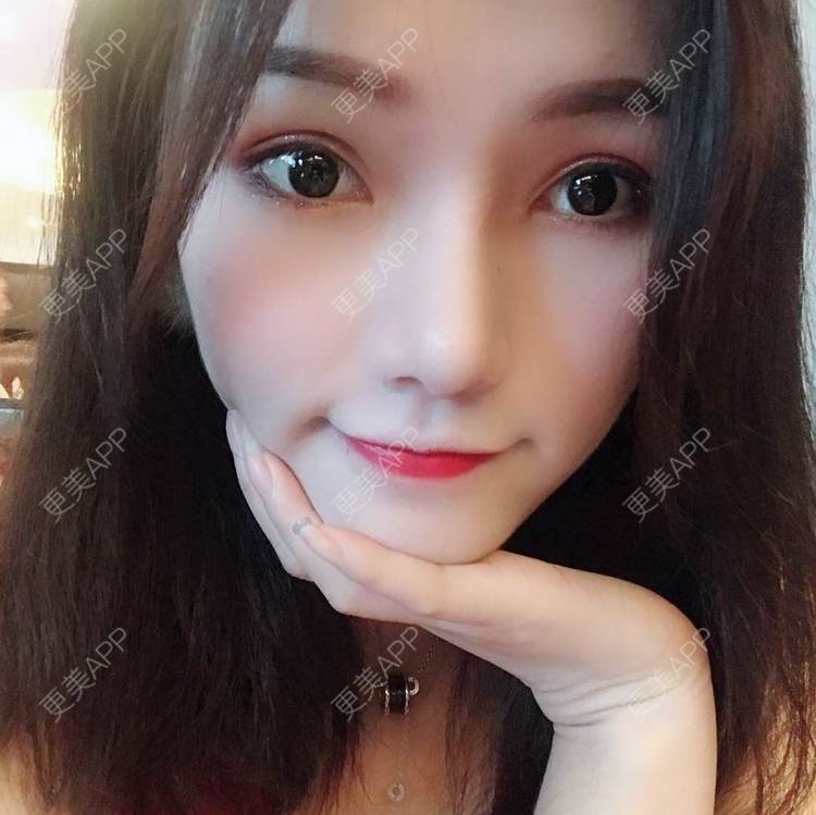 更美 - 美美的芝芝的自体脂肪全面部填充经验 | 广州 | 自体脂肪全面部填充