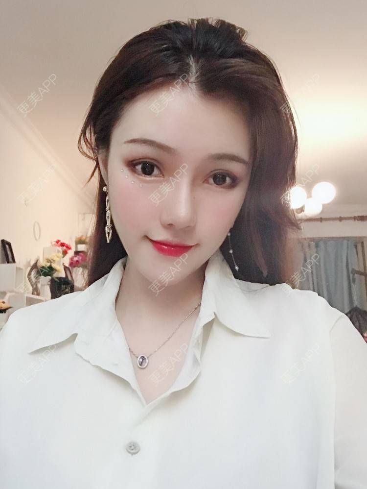 更美 - 美美的芝芝的自体脂肪全面部填充经验 | 广州 | 自体脂肪全面部填充