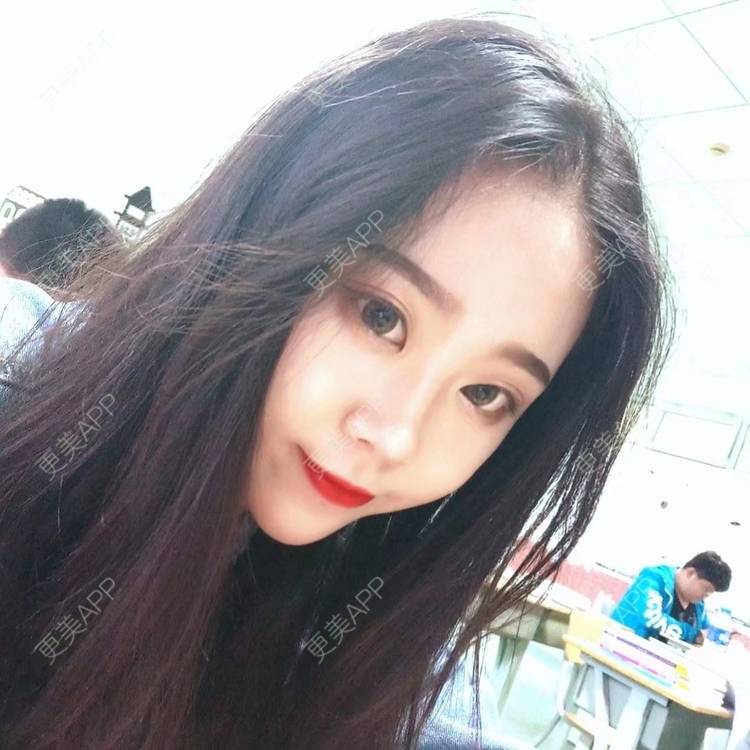 更美 - 更美用户vFETzv4uga的自体脂肪全面部填充经验 | 广州 | 自体脂肪全面部填充