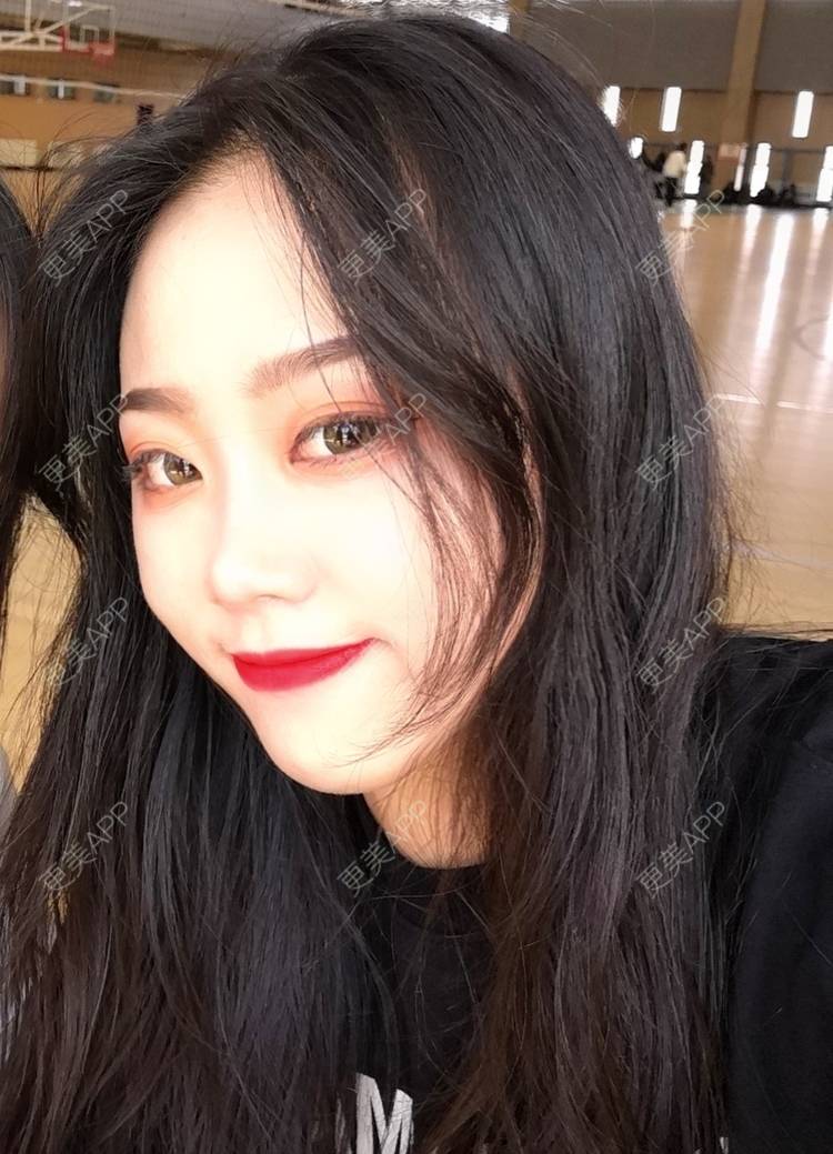 更美 - 更美用户vFETzv4uga的自体脂肪全面部填充经验 | 广州 | 自体脂肪全面部填充