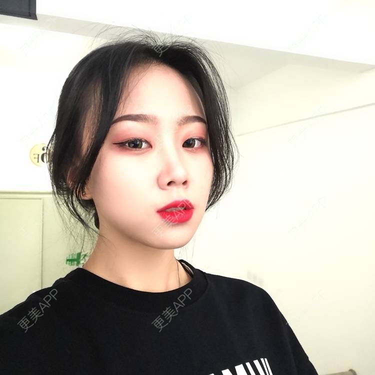 更美 - 更美用户vFETzv4uga的自体脂肪全面部填充经验 | 广州 | 自体脂肪全面部填充