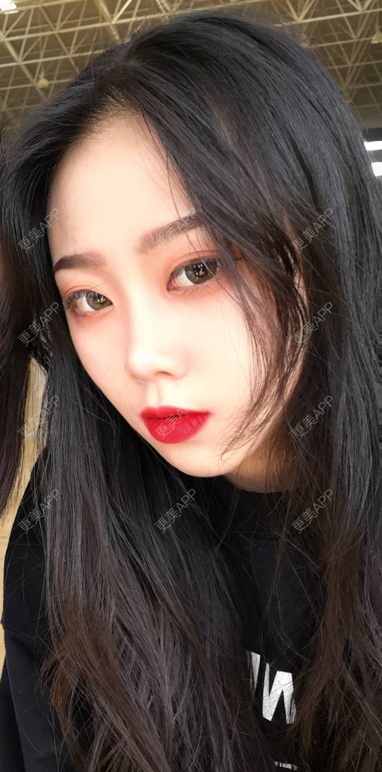 更美 - 更美用户vFETzv4uga的自体脂肪全面部填充经验 | 广州 | 自体脂肪全面部填充