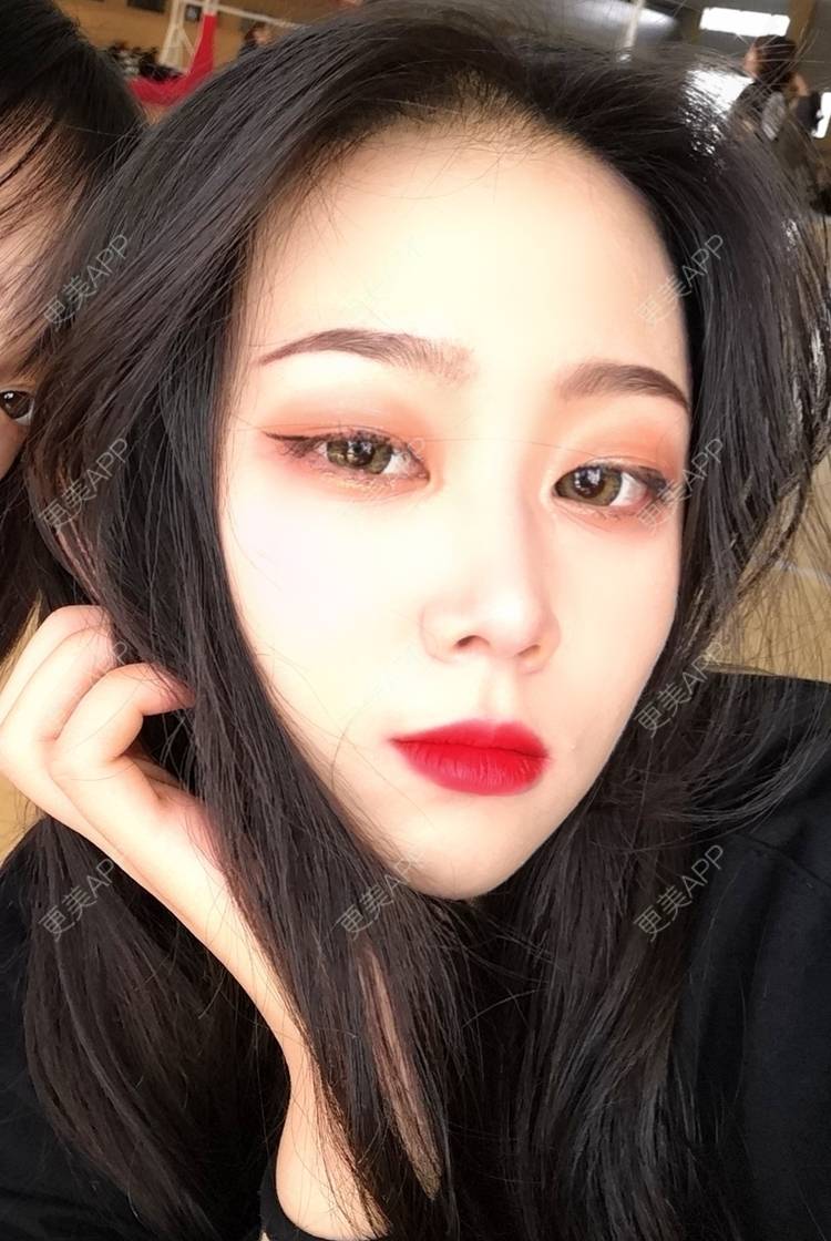 更美 - 更美用户vFETzv4uga的自体脂肪全面部填充经验 | 广州 | 自体脂肪全面部填充