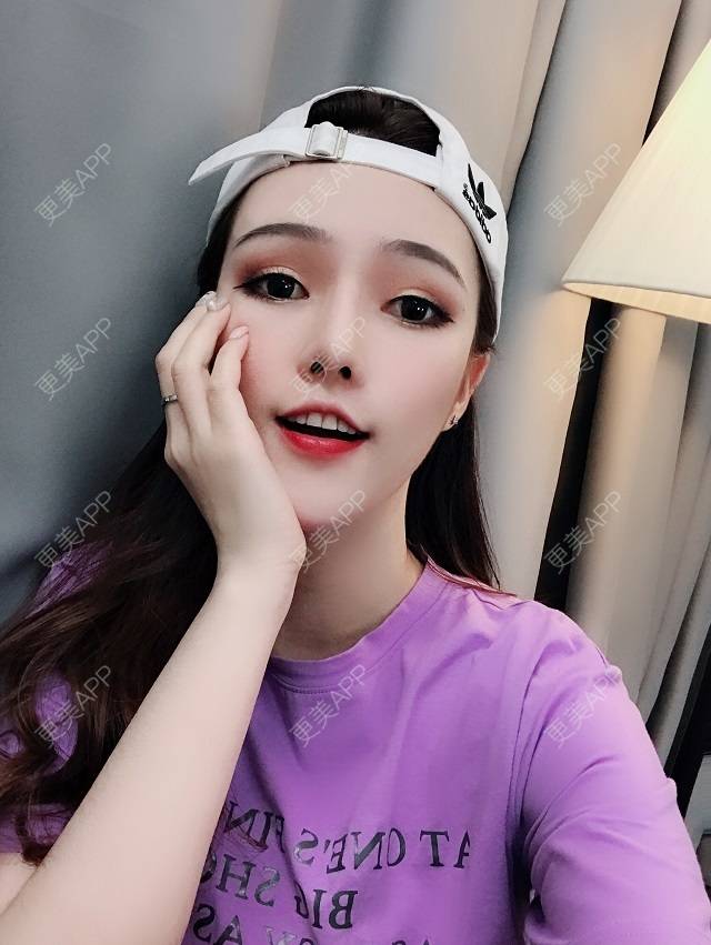 更美 - 美美的芝芝的自体脂肪全面部填充经验 | 广州 | 自体脂肪全面部填充