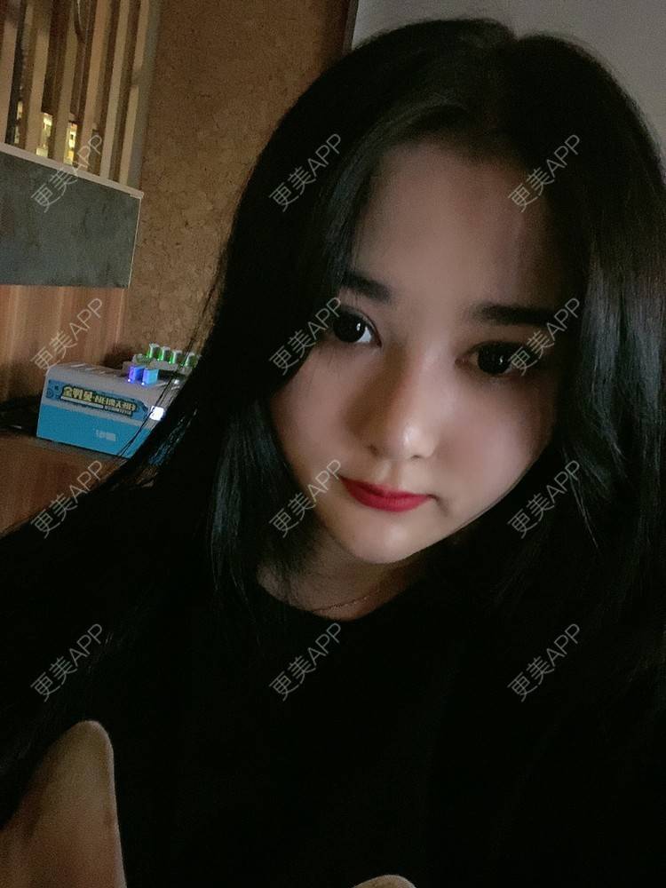 更美 - 无需解释收的鼻部多项经验 | 鼻部多项 | 膨体隆鼻 | 肋软骨隆鼻 | 重庆 | 鼻小柱延长 | 鼻形态修复