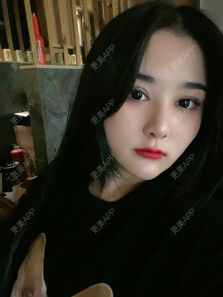更美 - 无需解释收的鼻部多项经验 | 鼻部多项 | 膨体隆鼻 | 肋软骨隆鼻 | 重庆 | 鼻小柱延长 | 鼻形态修复