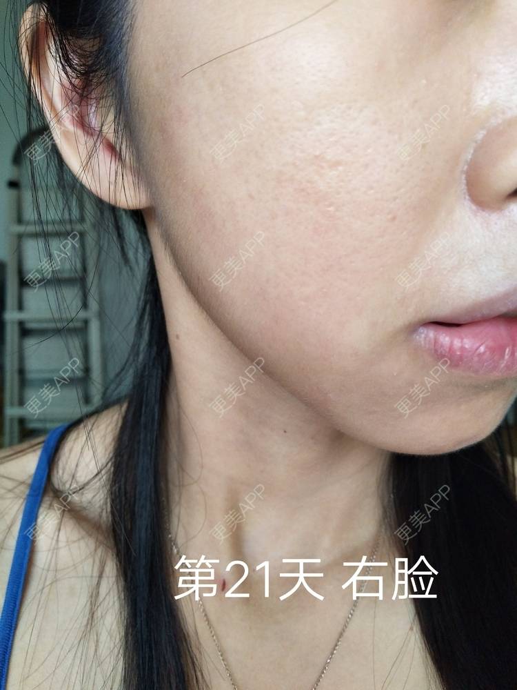 更美 - 更美用户YIHN9SmlH7的射频提升经验 | 深圳 | 射频提升