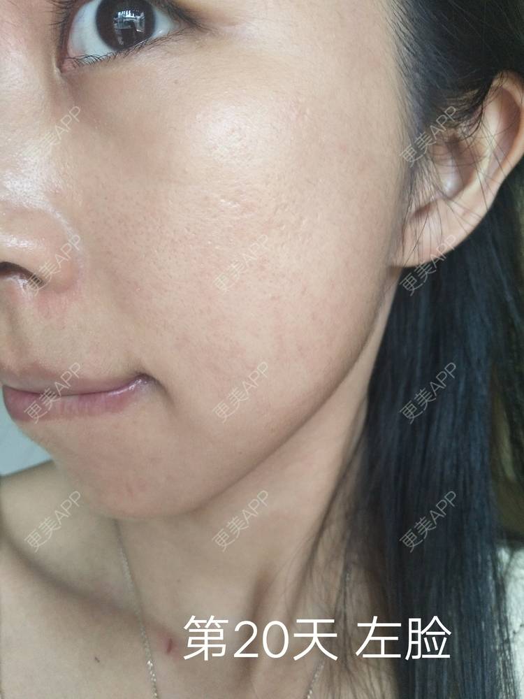 更美 - 更美用户YIHN9SmlH7的射频提升经验 | 深圳 | 射频提升