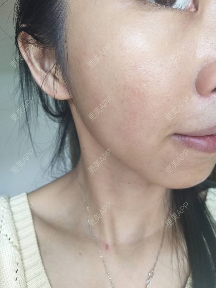 更美 - 更美用户YIHN9SmlH7的射频提升经验 | 深圳 | 射频提升