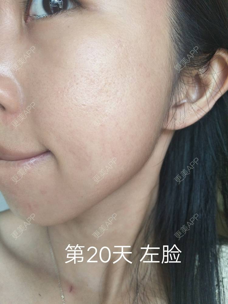 更美 - 更美用户YIHN9SmlH7的射频提升经验 | 深圳 | 射频提升