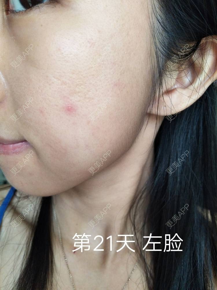 更美 - 更美用户YIHN9SmlH7的射频提升经验 | 深圳 | 射频提升