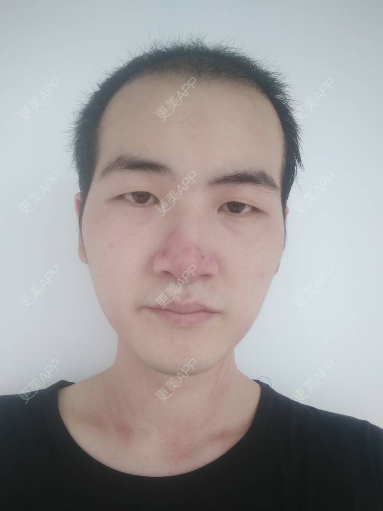 更美 - 更美用户wHSFRCieMm的植胡须经验 | 武汉 | 植胡须