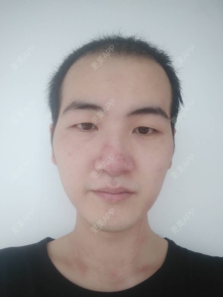 更美 - 更美用户wHSFRCieMm的植胡须经验 | 武汉 | 植胡须
