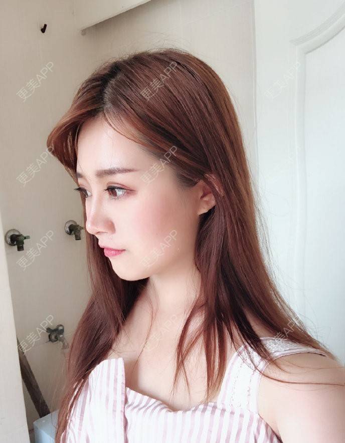 更美 - 准则的全切双眼皮经验 | 杭州 | 全切双眼皮